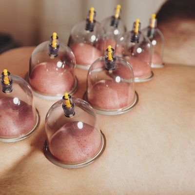 close-up-multiple-vacuum-cups-medical-cupping-therapy-human-body-doctor-with-cups